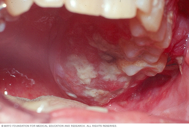 ds01089_im00214_c7_mouth_cancer_picturethu_jpg.jpg